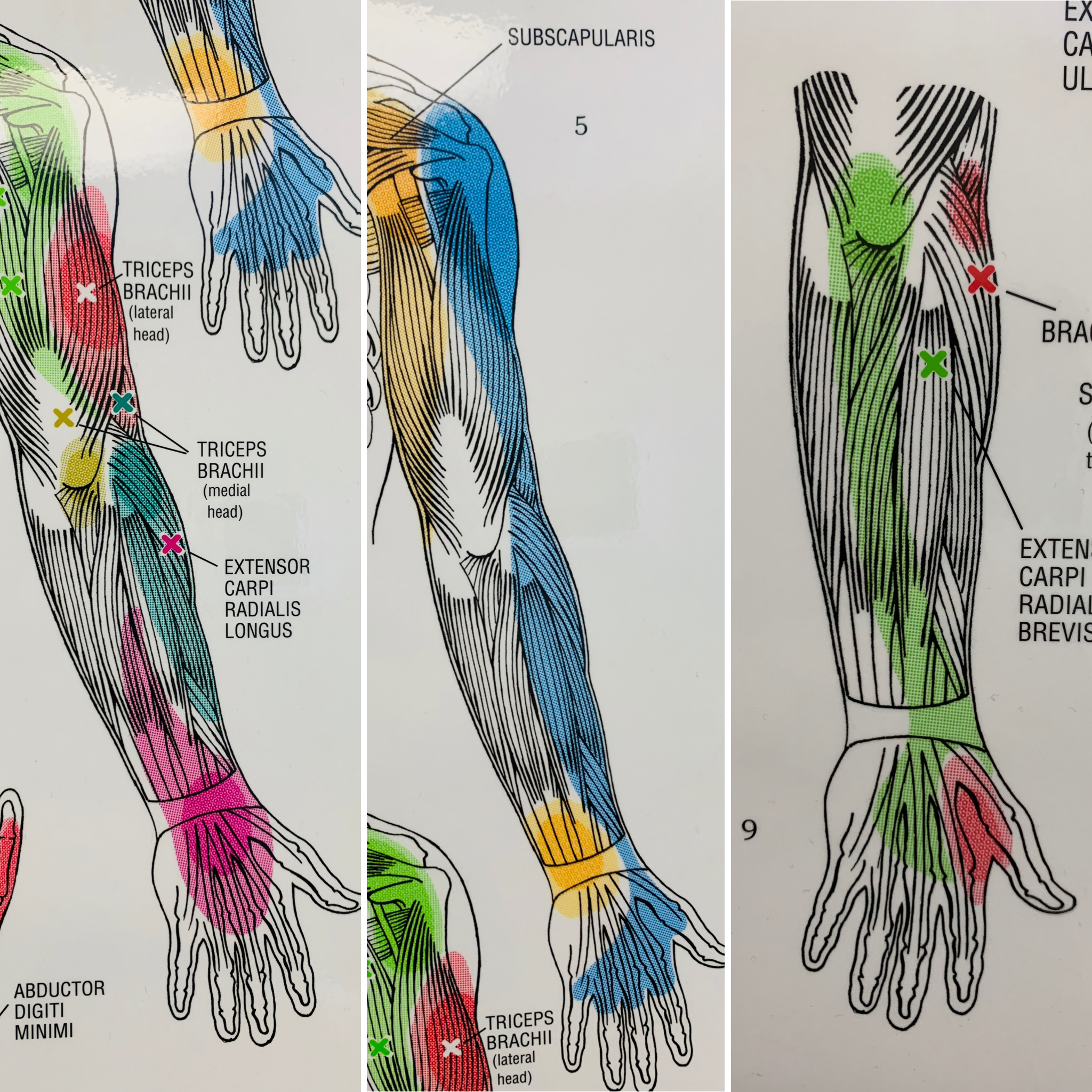 Pinched nerve pain in shoulder