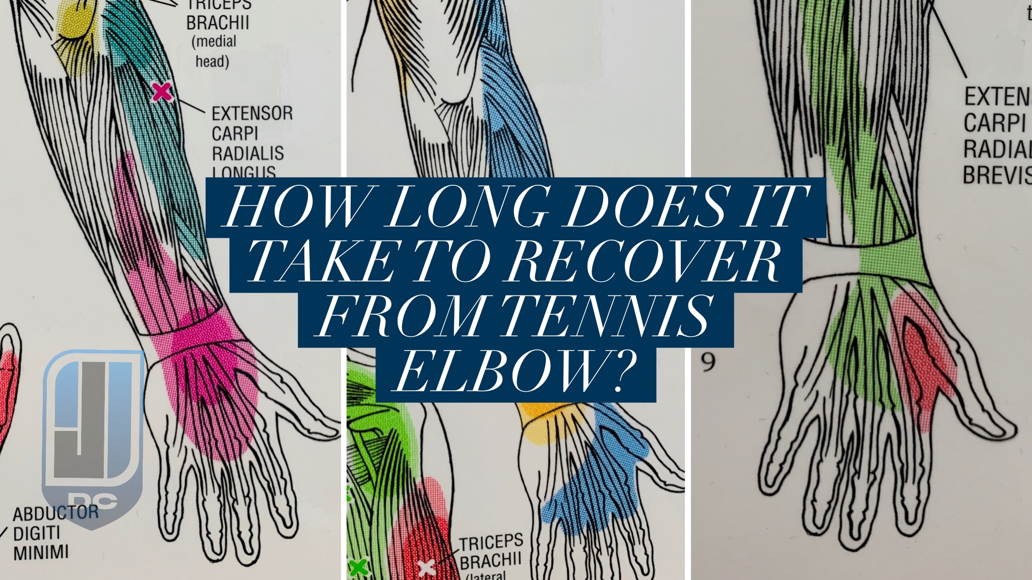 tennis elbow recovery